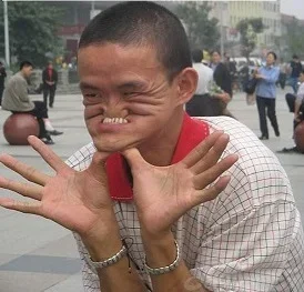 underbite - Copy.webp